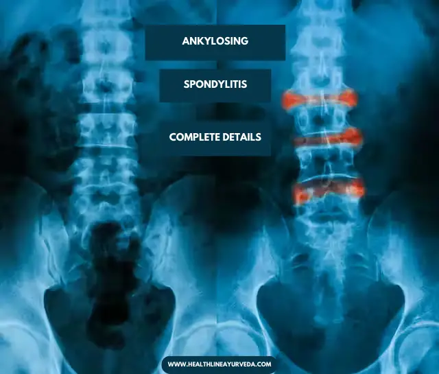 ANKYLOSING SPONDYLITIS